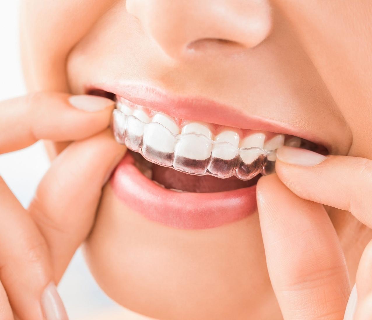 Aligners are also called Invisible braces